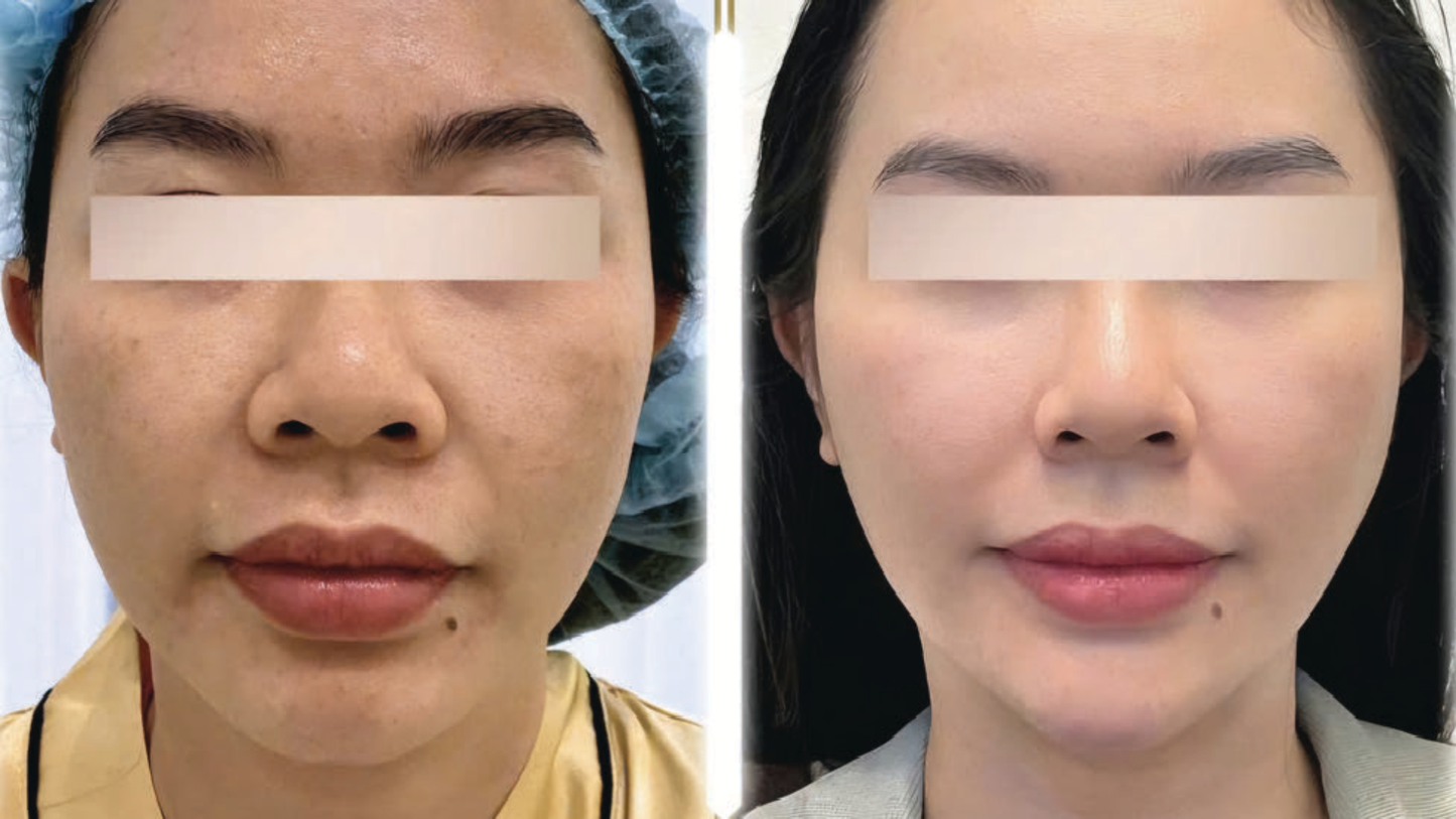 Resa’mon | Rejuvenating DNA Ampoule (PDRN 50,000ppm)