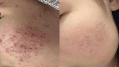 Resa’mon | Rejuvenating DNA Ampoule (PDRN 50,000ppm)