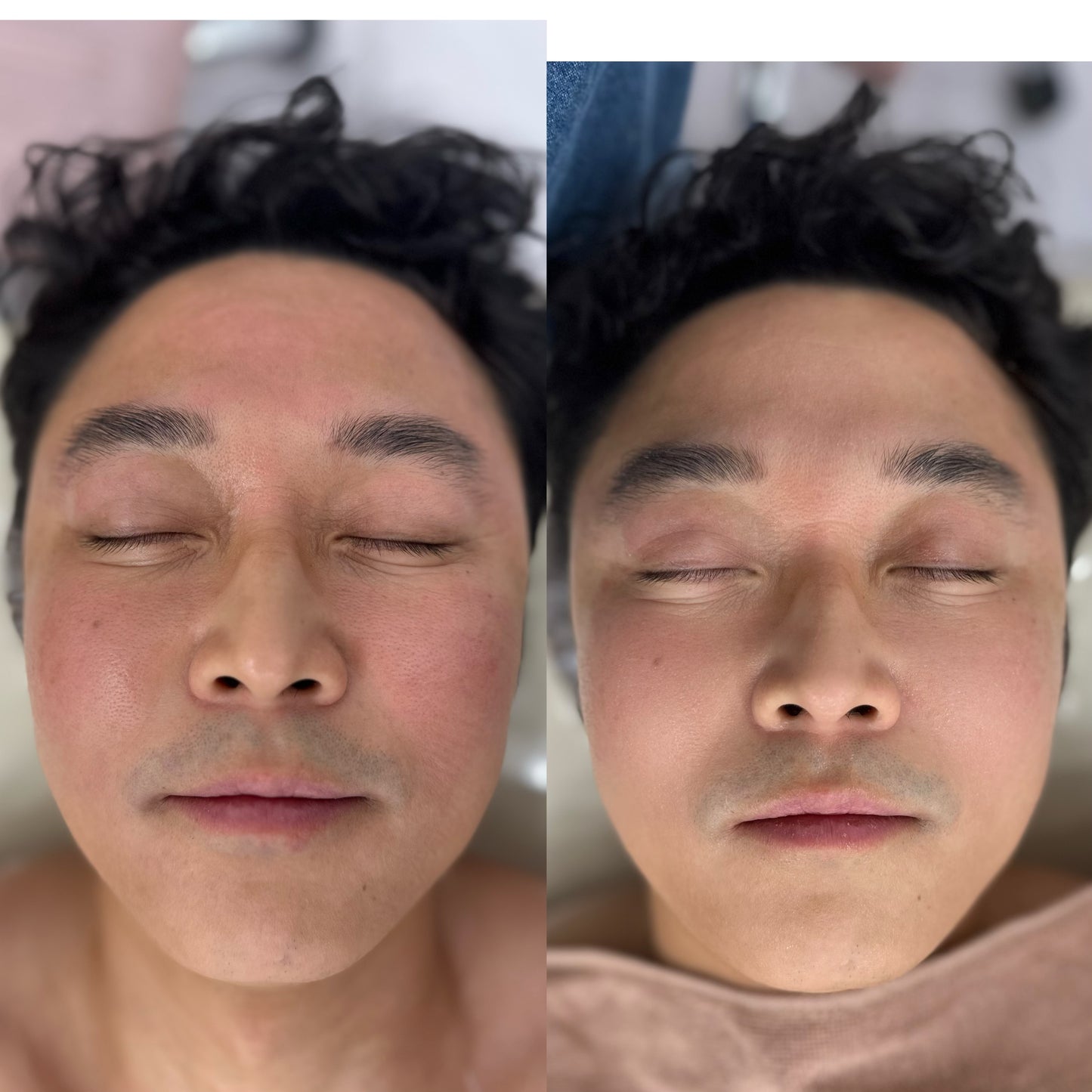 PDRN Intensive Recovery Protocol